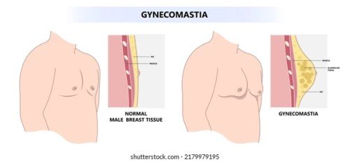 Gynecomastia